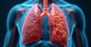 Rak płuca: Przyczyny, objawy, leczenie i rokowania