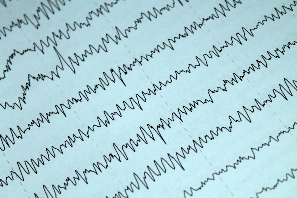 EEG – co to za badanie i co pokazuje zapis fal mózgowych? EEG – co to za badanie i co pokazuje zapis fal mózgowych?