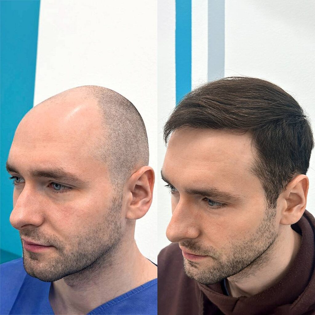 Przeszczep włosów w Krakowie – co warto wiedzieć przed zabiegiem? FullFace Clinic wyjaśnia